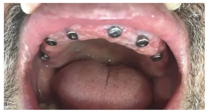 Antes: implantes All-on-4 en maxilar