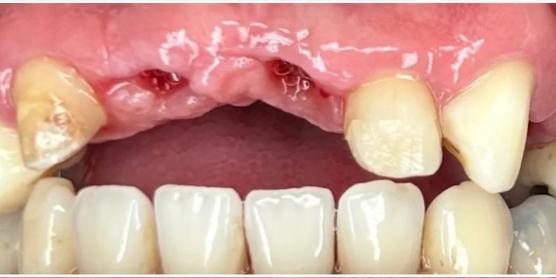 Proceso de tratamiento