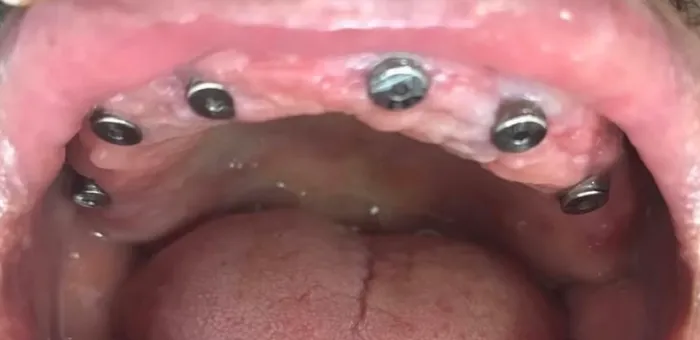 Así llegó: la arcada superior sin dientes, con seis implantes ya colocados