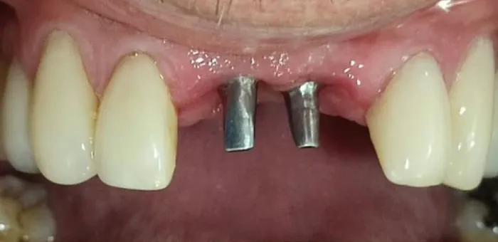 Así llegó: faltaban los dos dientes de adelante; se ven los pilares de los implantes