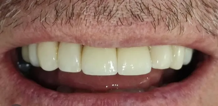 Así quedó: los dos dientes repuestos con coronas sobre implantes