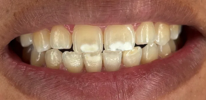 Así llegó: dientes con manchas blancas y desparejos