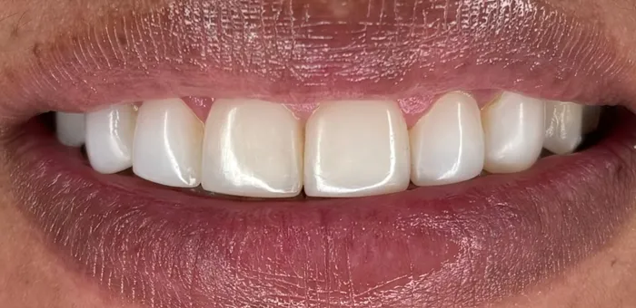 Así quedó: dientes blancos y parejos