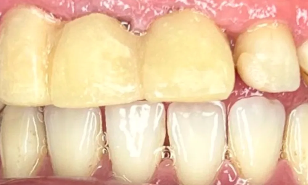 Antes: coronas viejas, amarillas y desgastadas en los dientes de adelante