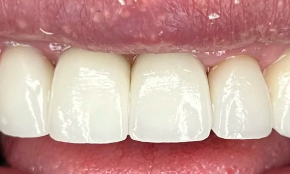 Después: coronas nuevas en los dientes de adelante, vistas con el labio