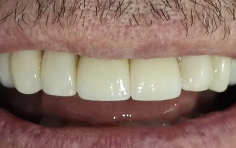 Resultado de implante dental — sonrisa natural
